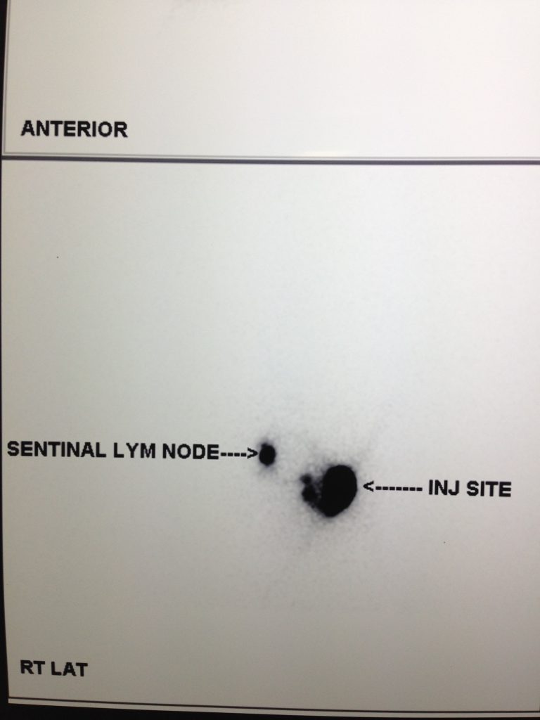 sentinel node biopsy draining underarm smell